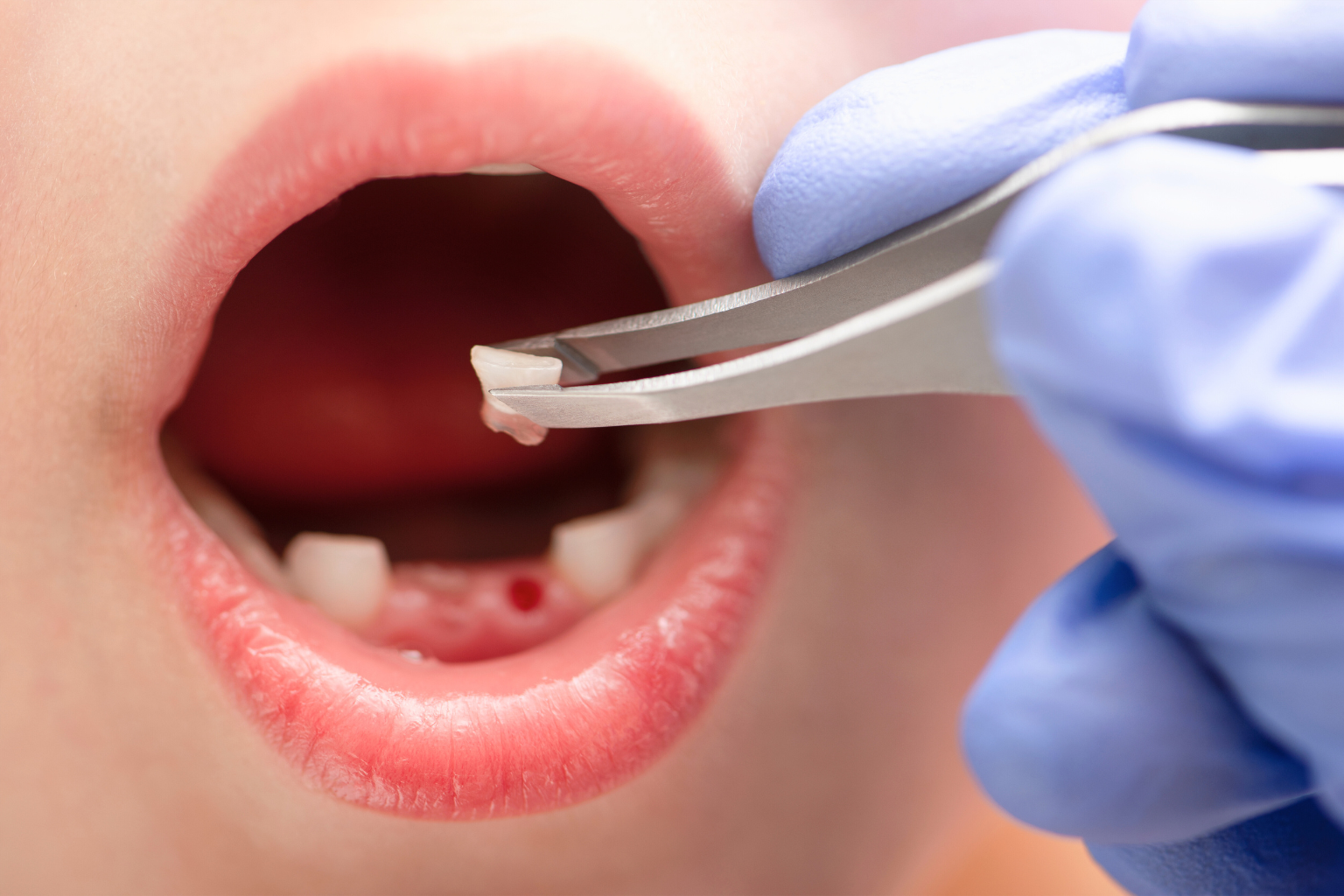 Gloved hand holding a tooth in tweezer above a child's gum.