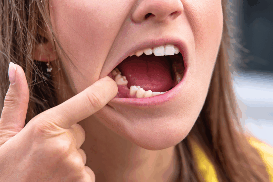 Woman pulling mouth open to show space from a missing tooth.