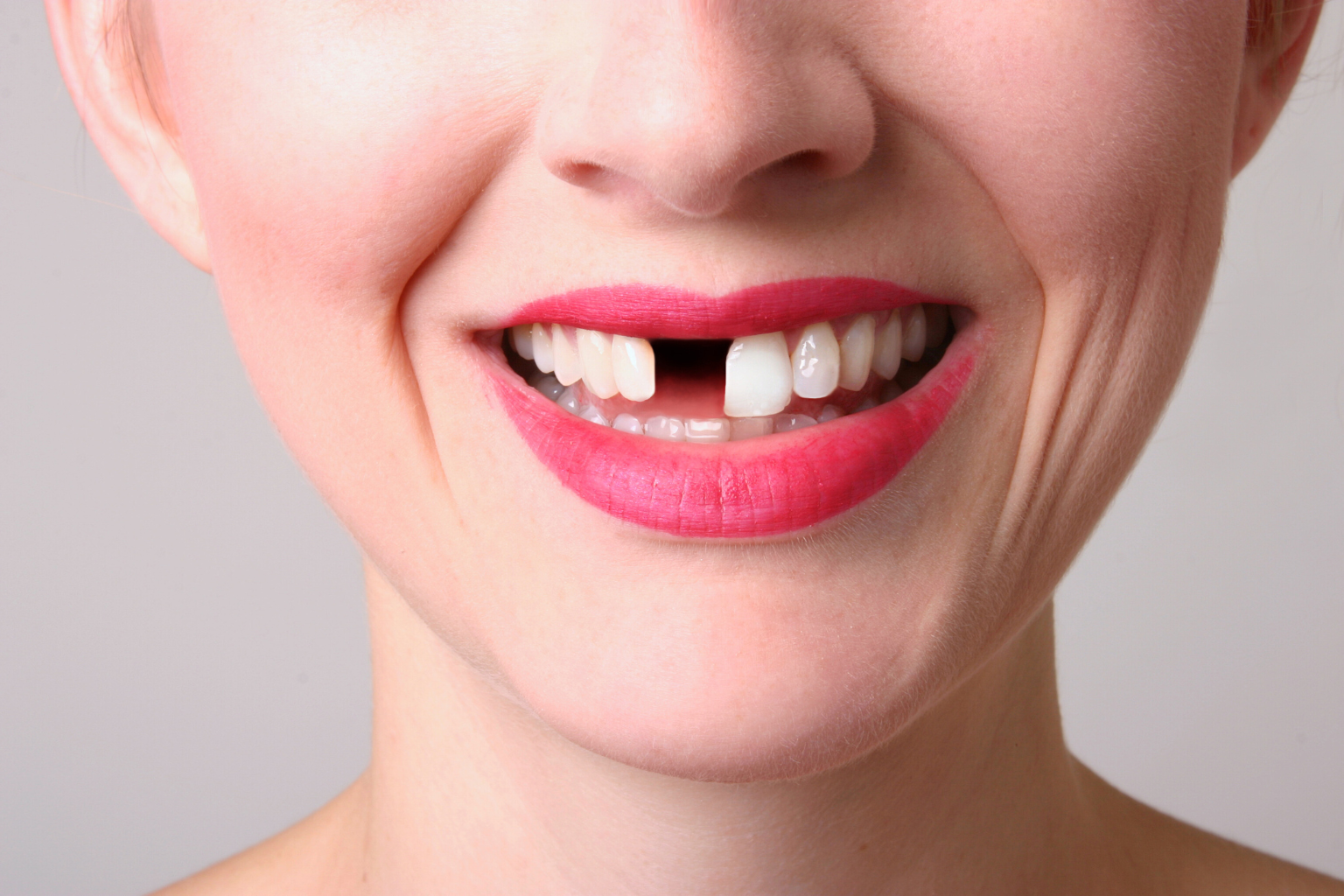 Woman's smile showing a space from a missing tooth.