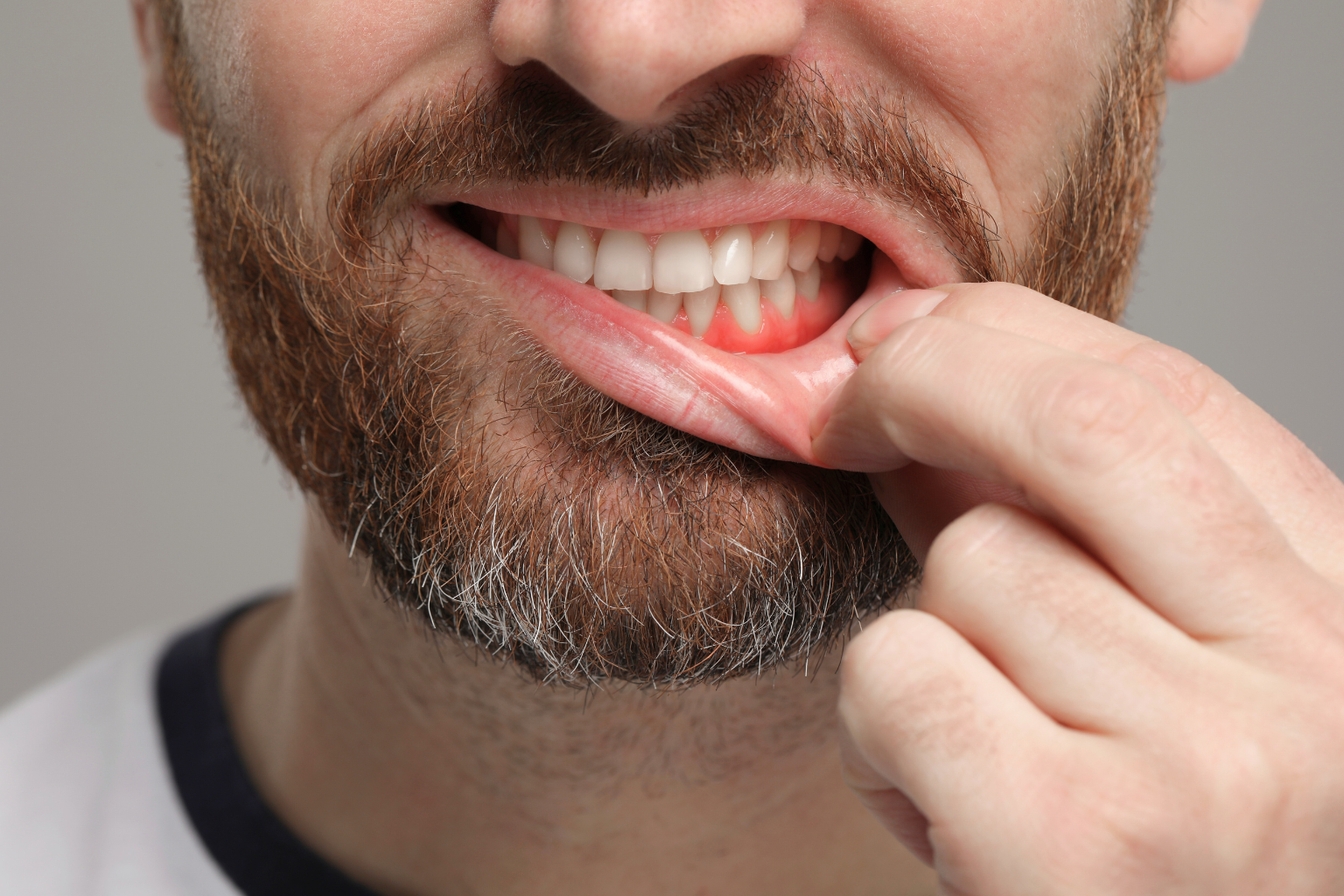 man pulling down lower lip to show inflamed gums