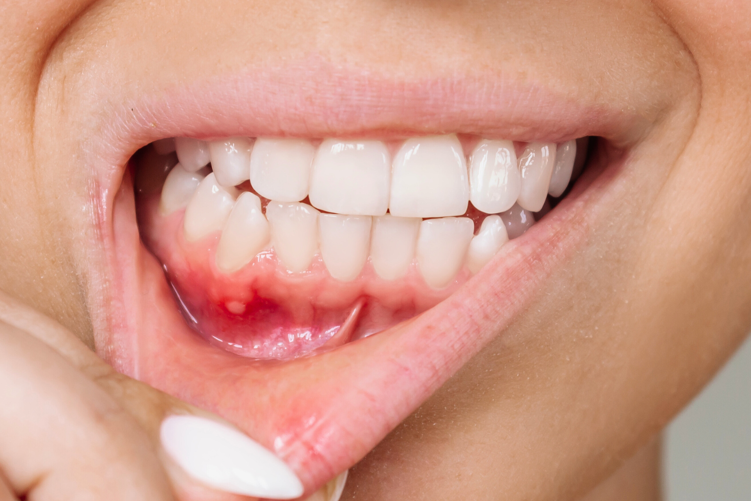 woman pulling down lower lip to show inflamed gum