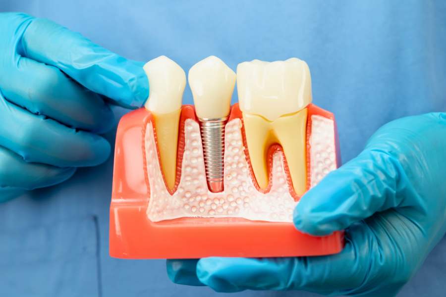 Gloved hands holding jaw model with implant and crown.