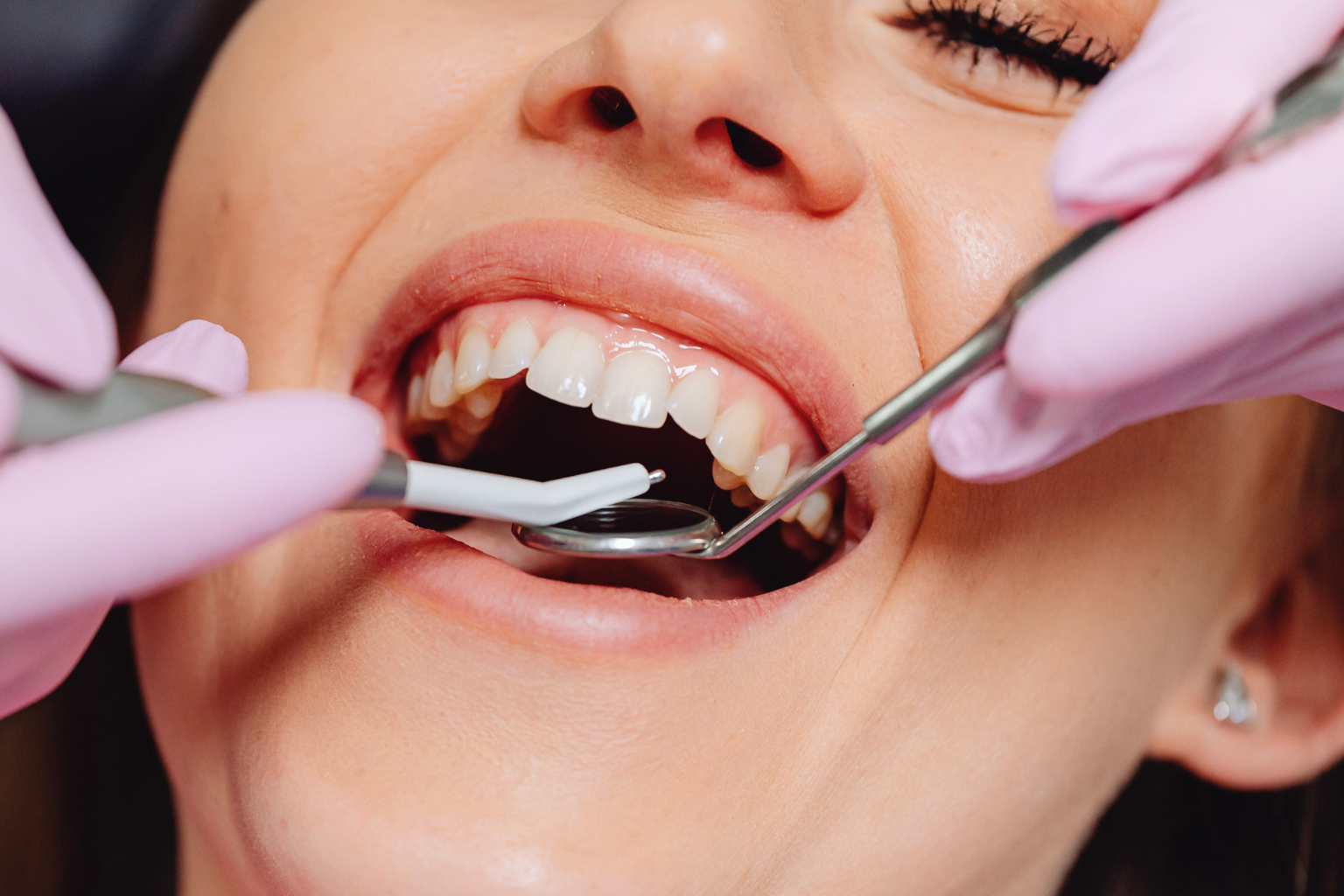 Gloved hands using dental tools in woman's mouth.