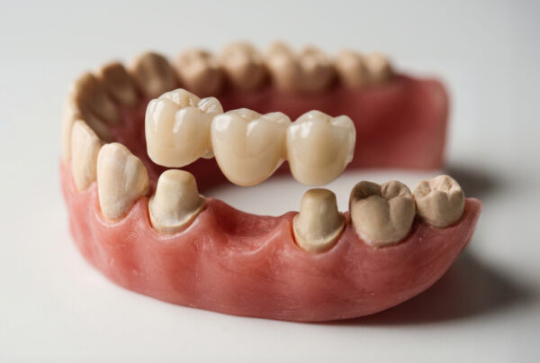 Dental bridge hovering above two dental implants in mandible model.