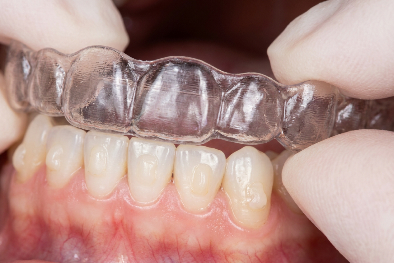 Gloved hands placing clear aligner over bottom teeth.