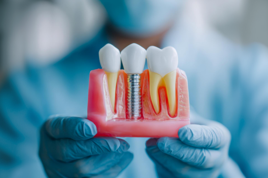 Gloved hand holding a model of a dental implant between two teeth.